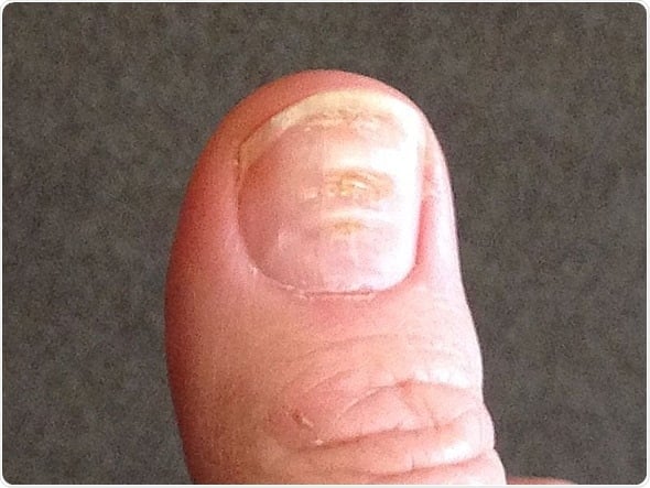 What Do Your Nails Say About Kidney Disease Walkin Lab