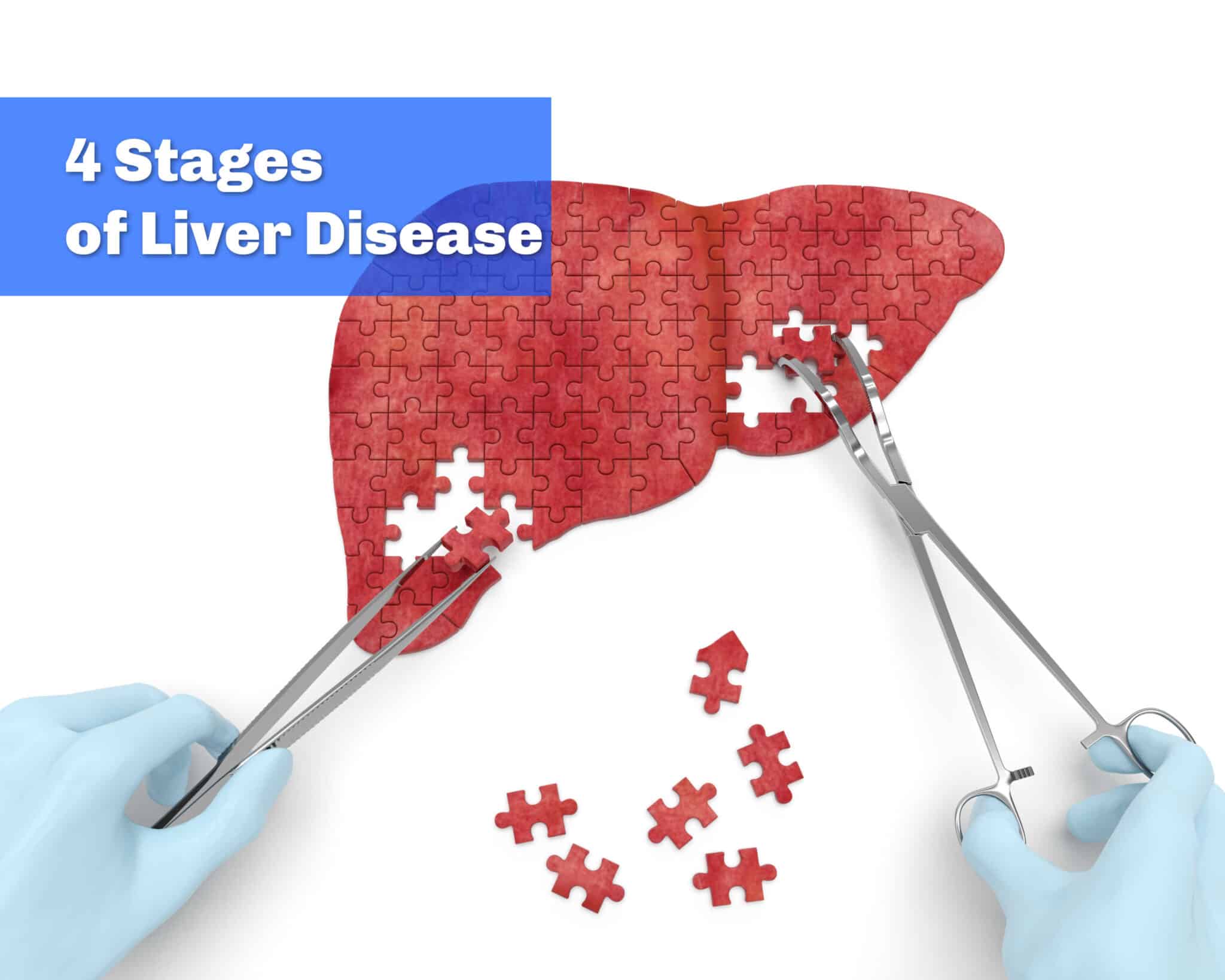 what-are-the-four-stages-of-liver-disease-walkin-lab