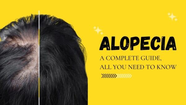 Alopecia: A complete guide, all you need to know