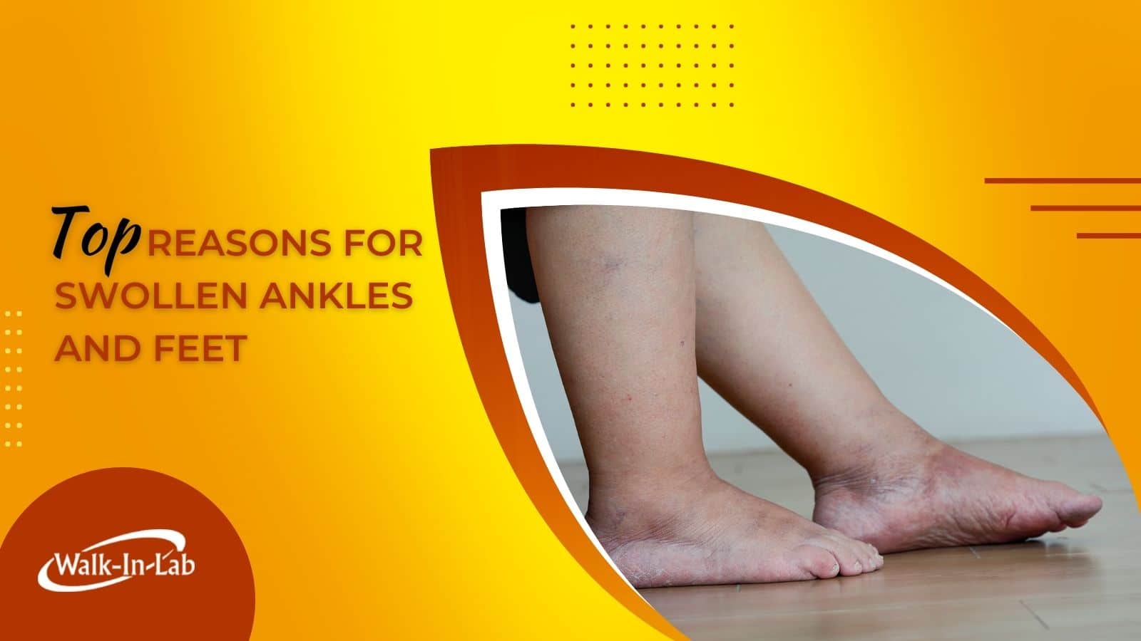 Top Reasons For Swollen Ankles And Feet | Walk-In Lab