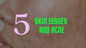 Skin issues and acne