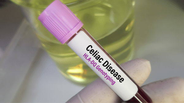 Understanding the Tissue Transglutaminase (tTG) Blood Test for Celiac ...