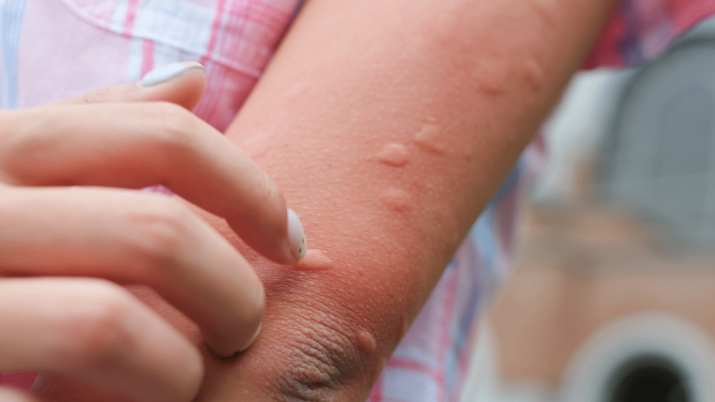 Medical Interventions for Mosquito Cellulitis